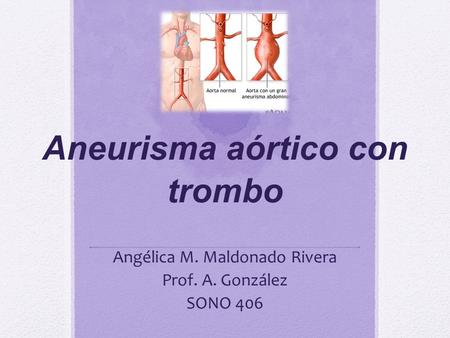 Aneurisma aórtico con trombo Angélica M. Maldonado Rivera Prof. A. González SONO 406.