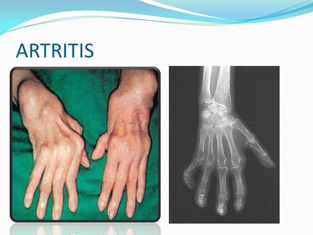 ARTRITIS. ARTRITIS. Es una enfermedad degenerativa de las articulaciones consistente en la inflamación o desgaste de una articulación. El término artritis.