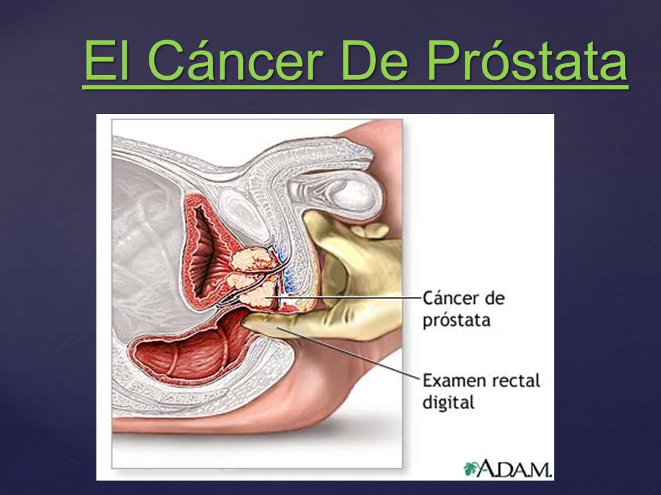 cancer de prostata ppt papilom la nivelul ochilor fardului