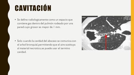 CAVITACIÓN Se define radiologicamente como un espacio que contiene gas dentro del pulmón rodeado por una pared cuyo grosor es mayor de 1 mm. Solo cuando.