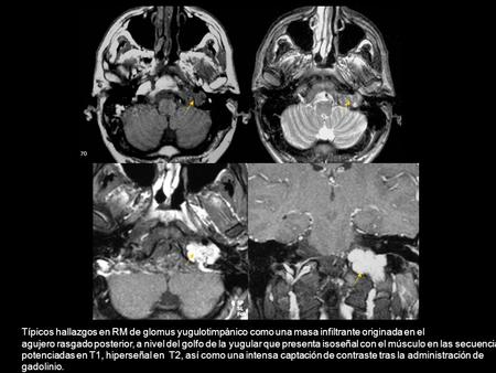 Típicos hallazgos en RM de glomus yugulotimpánico como una masa infiltrante originada en el agujero rasgado posterior, a nivel del golfo de la yugular.