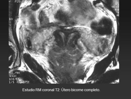 Estudio RM coronal T2: Útero bicorne completo.