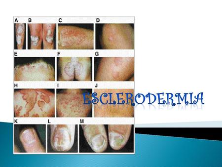 ESCLERODERMIA.