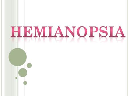 Se conoce como hemianopsia a la falta de visión o ceguera que afecta únicamente a la mitad del campo visual.