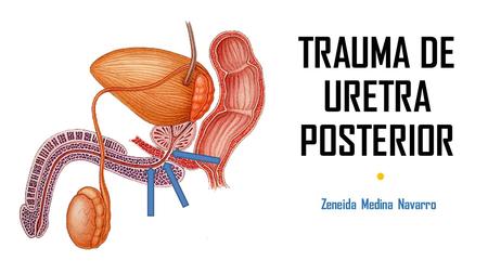 TRAUMA DE URETRA POSTERIOR Zeneida Medina Navarro.