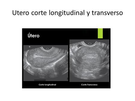 Utero corte longitudinal y transverso. Endometrio fino.