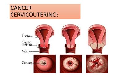 CÁNCER CERVICOUTERINO:. HISTOLOGIA DEL CÉRVIX La mucosa cervical mide unos 2 a 3 mm de espesor y es muy diferente del resto de la mucosa uterina porque.