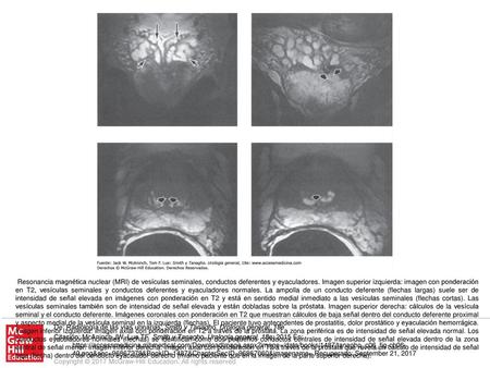 Resonancia magnética nuclear (MRI) de vesículas seminales, conductos deferentes y eyaculadores. Imagen superior izquierda: imagen con ponderación en T2,