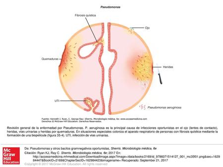 Revisión general de la enfermedad por Pseudomonas. P