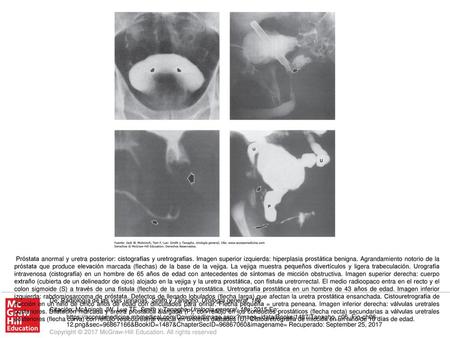 Próstata anormal y uretra posterior: cistografías y uretrografías
