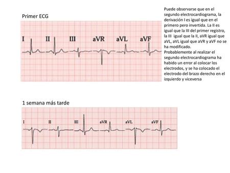 Primer ECG 1 semana más tarde