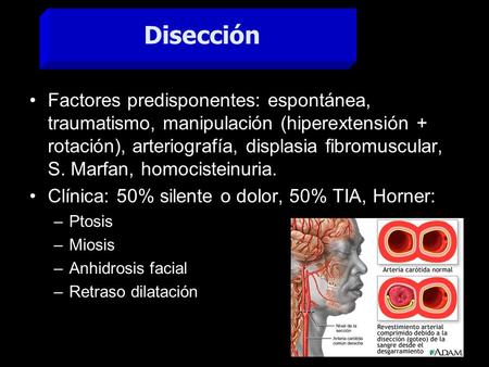 Disección Factores predisponentes: espontánea, traumatismo, manipulación (hiperextensión + rotación), arteriografía, displasia fibromuscular, S. Marfan,
