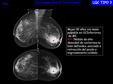 Carcinoma Ductal Infiltrante LQC TIPO 3 29a