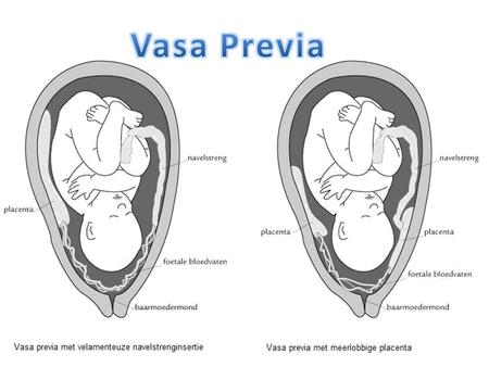 Definición Vasa previa: Es el término utilizado para describir vasos de origen fetal que discurren a través de las membranas, sin la protección del cordón.