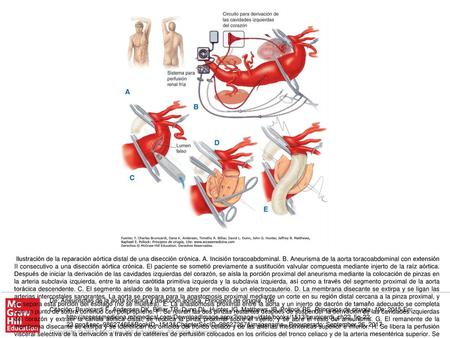 Ilustración de la reparación aórtica distal de una disección crónica. A. Incisión toracoabdominal. B. Aneurisma de la aorta toracoabdominal con extensión.