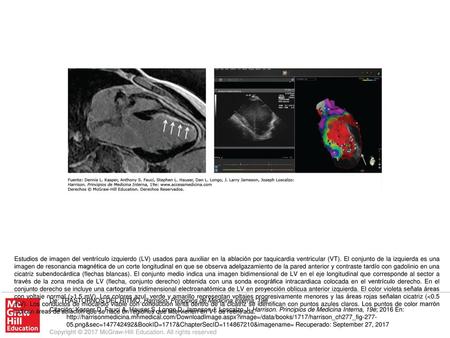 Estudios de imagen del ventrículo izquierdo (LV) usados para auxiliar en la ablación por taquicardia ventricular (VT). El conjunto de la izquierda es una.