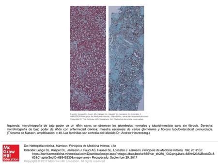 Izquierda: microfotografía de bajo poder de un riñón sano; se observan los glomérulos normales y tubulointersticio sano sin fibrosis. Derecha: microfotografía.