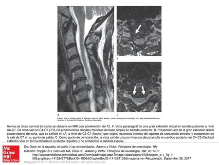 Hernia de disco cervical tal como se observa en MRI con ponderación de T2. A. Vista parasagital de una gran extrusión discal en sentido posterior a nivel.