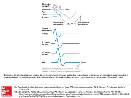 Disposición de los electrodos para estudios de conducción motora del nervio cubital. Las respuestas se registran con un electrodo de superficie sobre el.