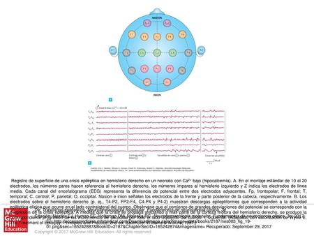 Registro de superficie de una crisis epiléptica en hemisferio derecho en un neonato con Ca2+ bajo (hipocalcemia). A. En el montaje estándar de 10 al 20.