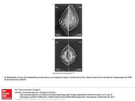 A) Mastografía normal; B) mastografía que demuestra una neoplasia maligna. Cortesía de la Dra. Rosario García de la Unidad de Imagenología de CMN 20 de.
