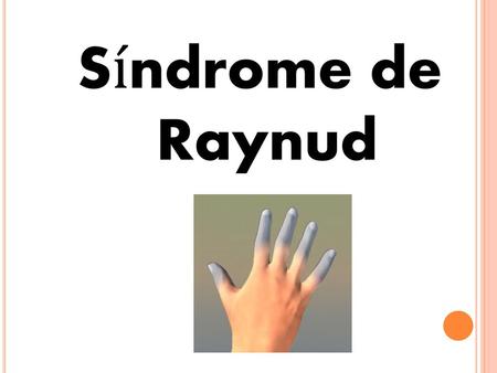 Síndrome de Raynud.