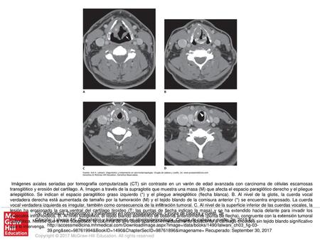 Imágenes axiales seriadas por tomografía computarizada (CT) sin contraste en un varón de edad avanzada con carcinoma de células escamosas transglótico.