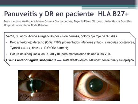 Panuveítis y DR en paciente HLA B27+