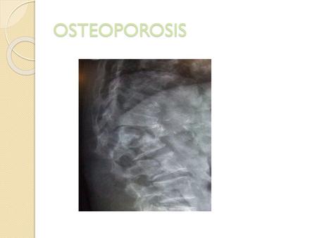 OSTEOPOROSIS.