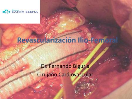 Revascularización Ilio-Femoral