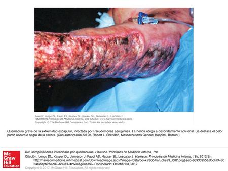 Quemadura grave de la extremidad escapular, infectada por Pseudomonas aeruginosa. La herida obliga a desbridamiento adicional. Se destaca el color pardo.