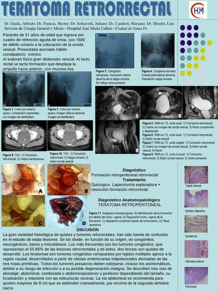 TERATOMA RETRORRECTAL