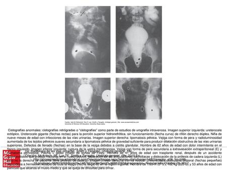 Cistografías anormales: cistografías retrógradas o “cistografías” como parte de estudios de urografía intravenosa. Imagen superior izquierda: ureterocele.