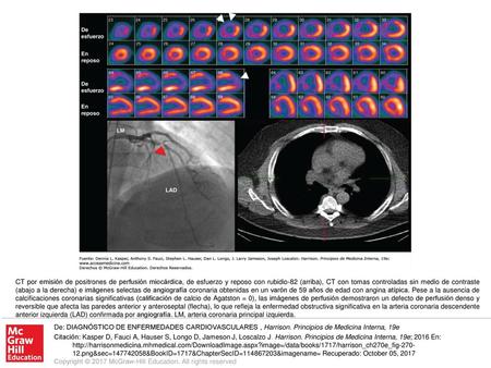 CT por emisión de positrones de perfusión miocárdica, de esfuerzo y reposo con rubidio-82 (arriba), CT con tomas controladas sin medio de contraste (abajo.