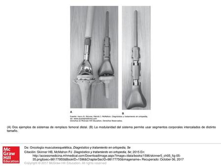 (A) Dos ejemplos de sistemas de remplazo femoral distal