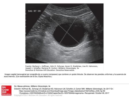 Imagen sagital transvaginal por ecografía de un ovario (compases) que contiene un quiste folicular. Se observan las paredes uniformes y la ausencia de.