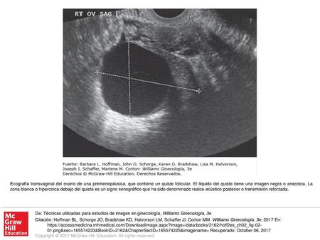 Ecografía transvaginal del ovario de una premenopáusica, que contiene un quiste folicular. El líquido del quiste tiene una imagen negra o anecoica. La.