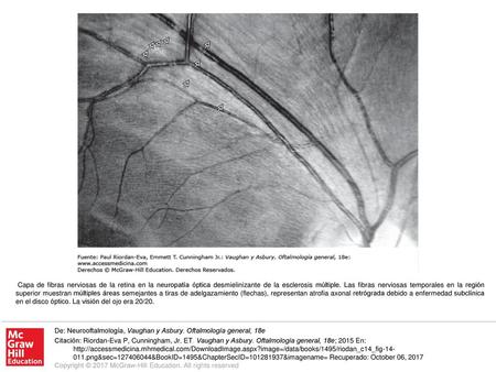 Capa de fibras nerviosas de la retina en la neuropatía óptica desmielinizante de la esclerosis múltiple. Las fibras nerviosas temporales en la región superior.