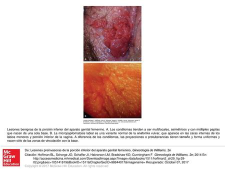 Lesiones benignas de la porción inferior del aparato genital femenino