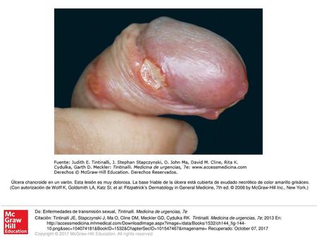 Úlcera chancroide en un varón. Esta lesión es muy dolorosa