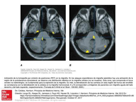 Activación de la tomografía por emisión de positrones (PET) en la migraña. En los ataques espontáneos de migraña episódica hay una activación de la región.
