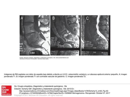 Imágenes de RM sagitales con dolor de espalda bajo debido a discitis en L5-S1, osteomielitis vertebral y un absceso epidural anterior pequeño. A: imagen.