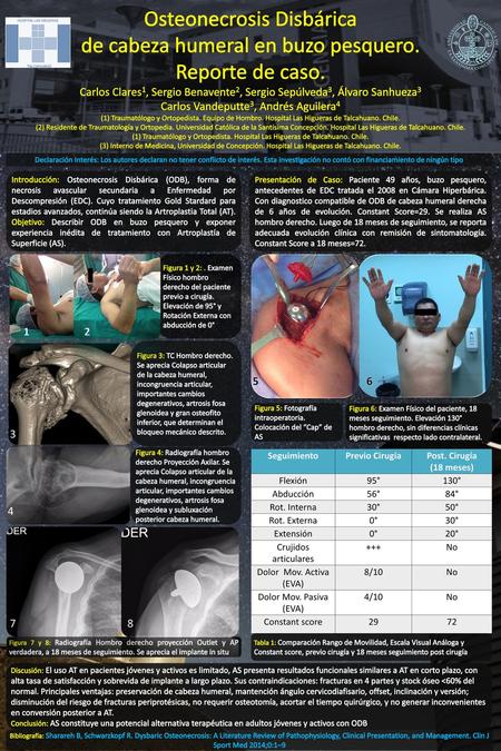 Osteonecrosis Disbárica de cabeza humeral en buzo pesquero.