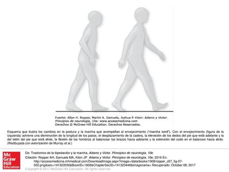 Esquema que ilustra los cambios en la postura y la marcha que acompañan al envejecimiento (“marcha senil”). Con el envejecimiento (figura de la izquierda)
