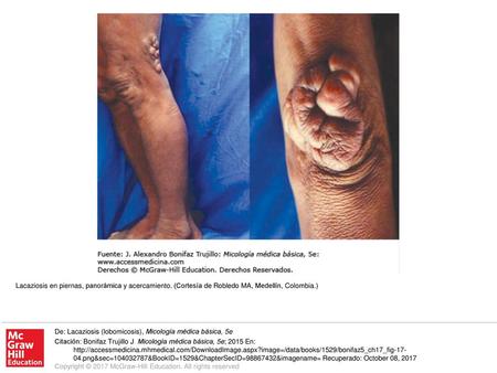 Lacaziosis en piernas, panorámica y acercamiento
