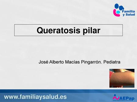 4/27/ :55 PM Queratosis pilar José Alberto Macías Pingarrón. Pediatra 