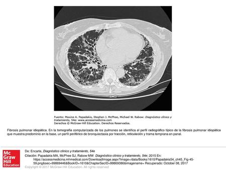 Fibrosis pulmonar idiopática