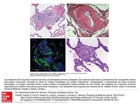 Las imágenes de la izquierda muestran ejemplos de arteriopatía pulmonar plexógena. Son lesiones obstructivas y proliferativas de las pequeñas arterias.