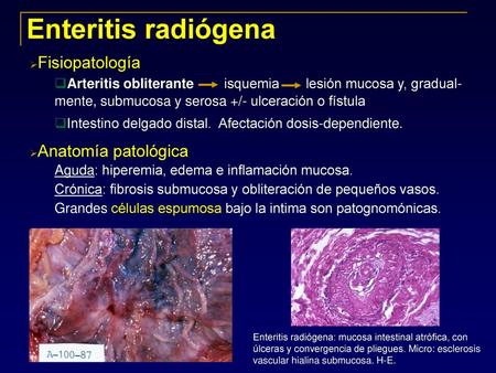 Enteritis radiógena Fisiopatología Anatomía patológica