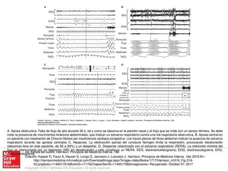 A. Apnea obstructiva. Falta de flujo de aire durante 30 s, tal y como se observa en la presión nasal y el flujo que se mide con un sensor térmico. Se debe.